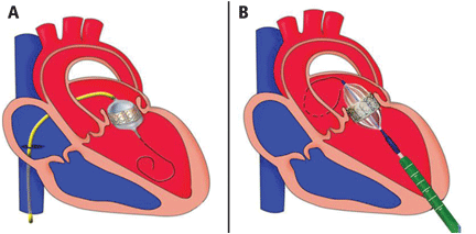 Transcatheter Heart Valve Replacement and Repair Market