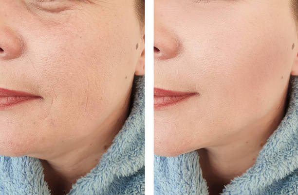 Age Spot Removal
