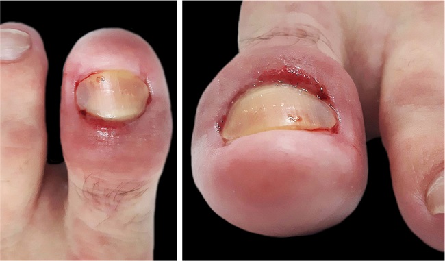 Matrix Removal Surgery