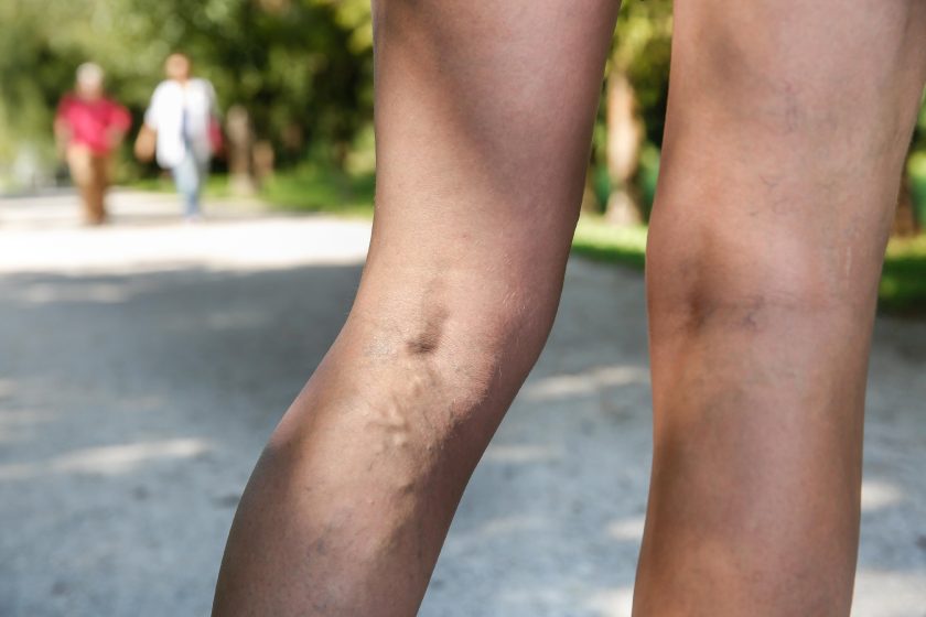 The Real Cost of Vein Treatment: Is It Worth the Investment?