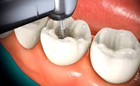 Root Canal Treatment